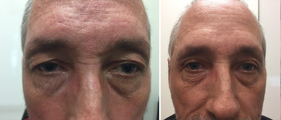 Before & Afters | Miami Cataract Surgery
