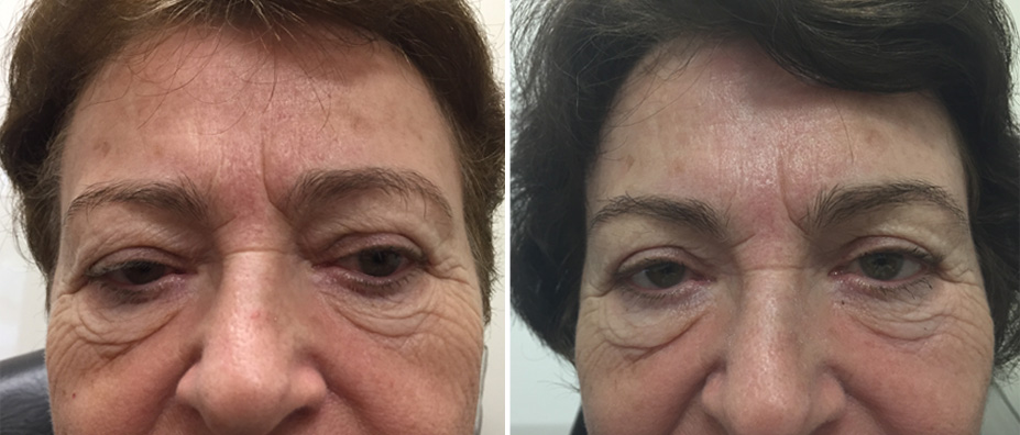 Before & Afters | Miami Cataract Surgery