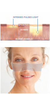 IPL Technology Process
