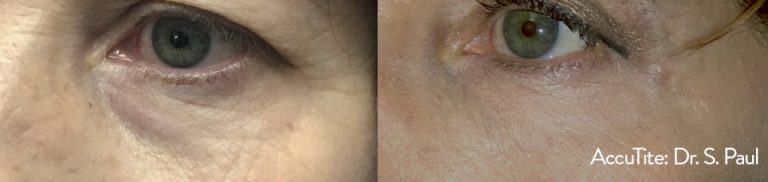 SP_1a_AccuTite_LowerLid-768x182